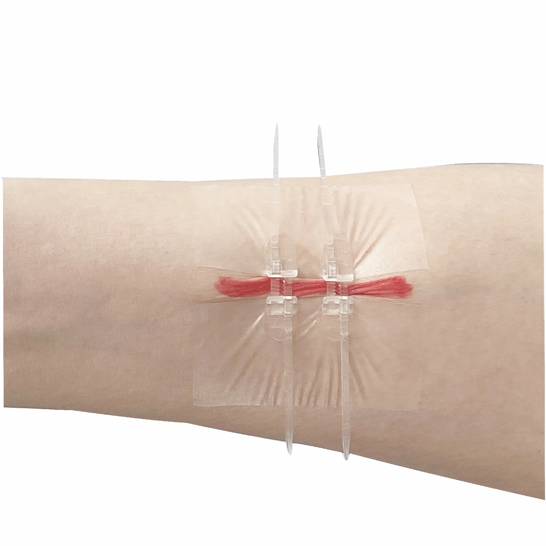 Zipper Pacemaker Closure Device Wound Closure Device Zip Suture 2in x 3in 4/Pack – Kerae Medical Inc.