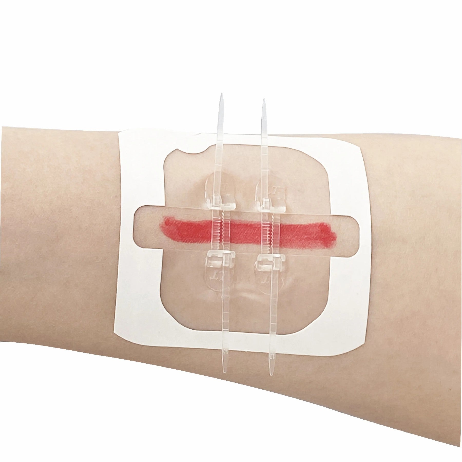 Zipper Pacemaker Closure Device Wound Closure Device Zip Suture 2in x 3in 4/Pack – Kerae Medical Inc.